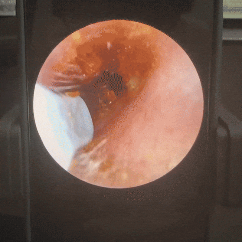 Slivor VisioEar : Une technologie pour la santé des oreilles approuvée par les médecins