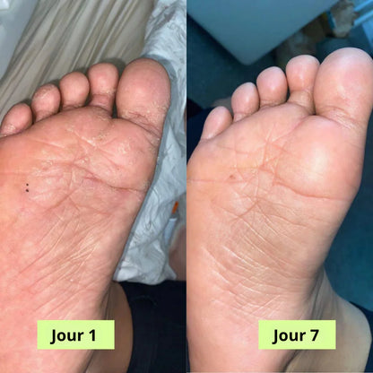 PuriFeet® Savon Purifiant Antifongique