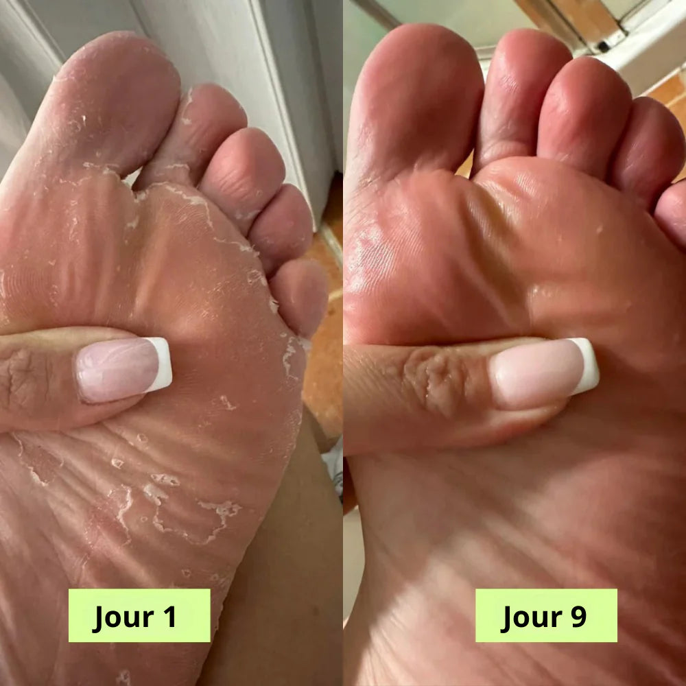 PuriFeet® Savon Purifiant Antifongique