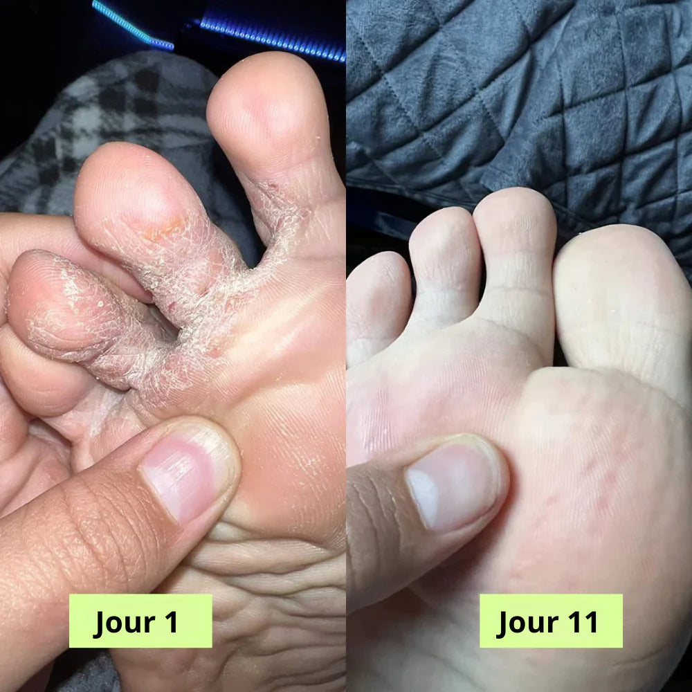 PuriFeet® Savon Purifiant Antifongique